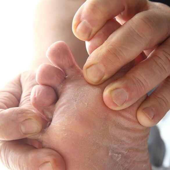 Ο μύκητας επηρεάζει το δέρμα ανάμεσα στα δάχτυλα των ποδιών
