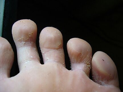 Το ξεφλούδισμα και το ξεφλούδισμα του δέρματος στα πόδια είναι σημάδι μύκητα