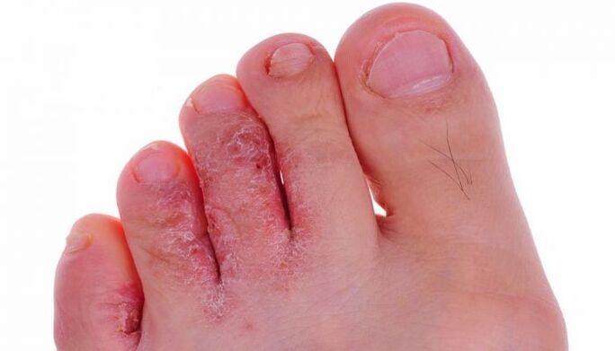 μυκητιασική μόλυνση του δέρματος των δακτύλων των ποδιών