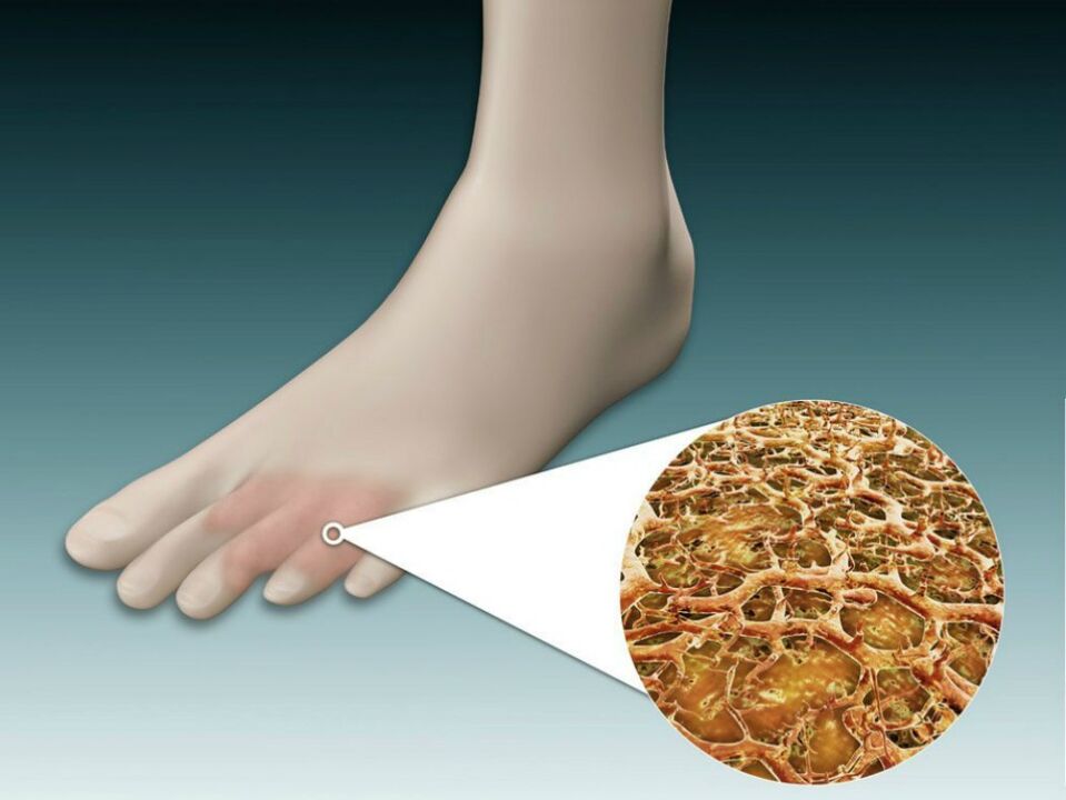 Ερυθρότητα του δέρματος μεταξύ και κοντά στα δάχτυλα των ποδιών με ενδοτριβικούς μύκητες